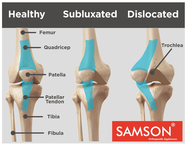 Samson Knee Cap Hinged with Open Patella and Deluxe Gel Pad for Arthritis, Sports Injury, Joint Pain Relief Knees Stabilizer and Support for Women and Men