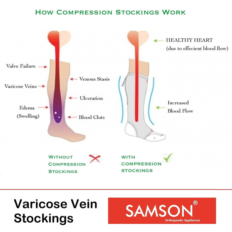 Samson Varicose Vein Stockings (Classic) (Pair) : For Varicose Veins, Blood Pools, Congestion, Spider Veins, DVT, Lymphedema (For Women & Men) (Thigh High)