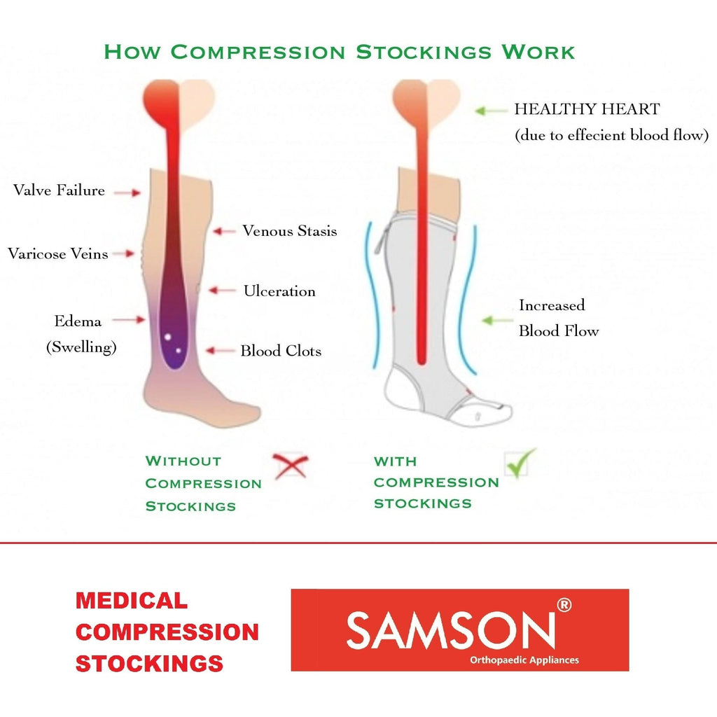 Samson Medical Compression Stockings (Class-1) (Pair) - For Varicose Veins, Blood Pools, Congestion, Spider Veins, DVT, Lymphedema (For Women & Men) (Thigh High)