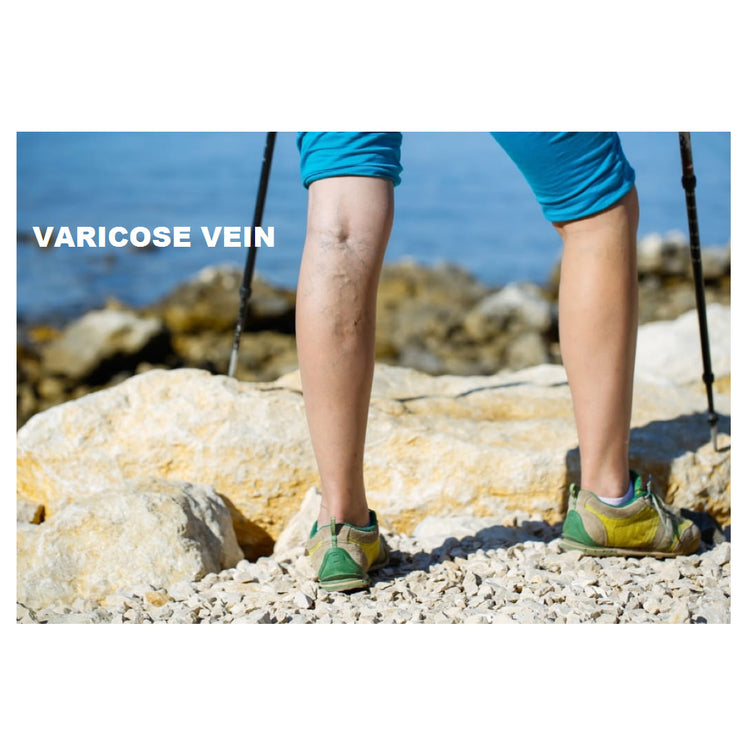 Samson Varicose Vein Stockings (Classic) (Pair) : For Varicose Veins, Blood Pools, Congestion, Spider Veins, DVT, Lymphedema (For Women & Men) (Knee High)