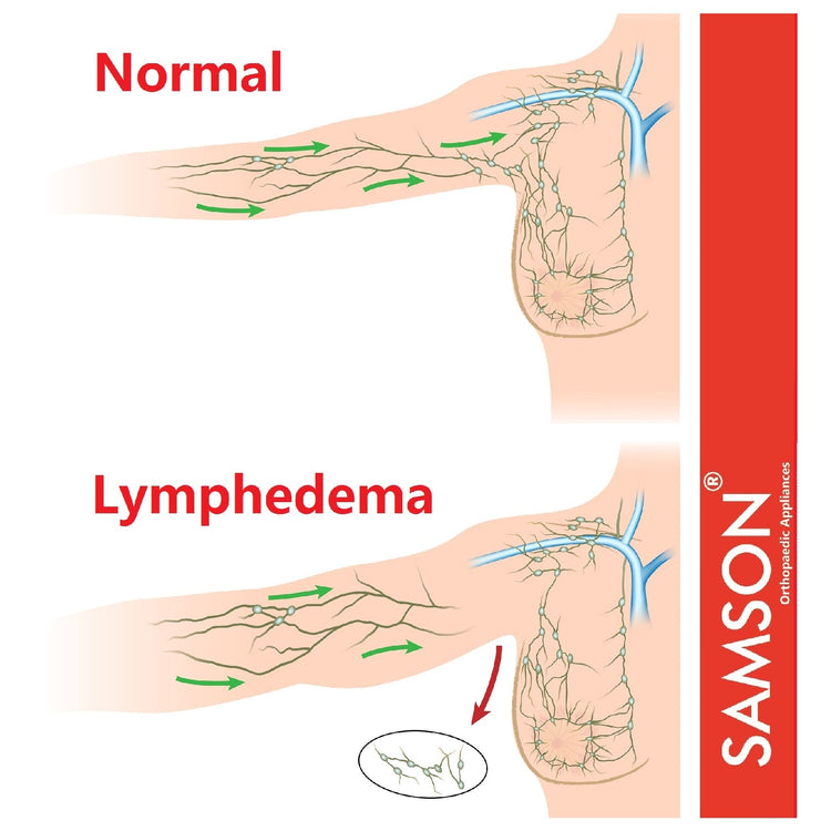 Samson Lymphedema Arm Sleeve (Single) - Compression Stocking Recommended by Doctors, For Post-Mastecomy & Lymphoedema of Hand and Arm, Extra-Firm Graduated Compression (For Women & Men)